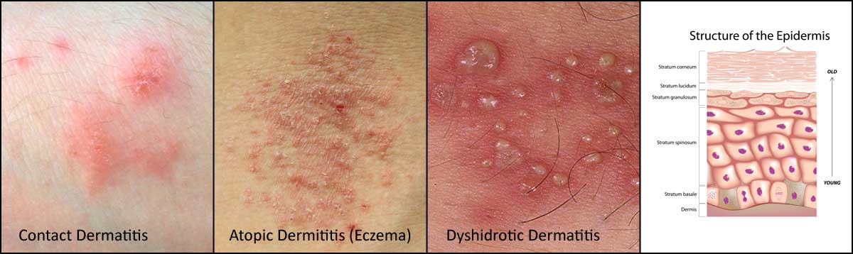 Types of dermatitis